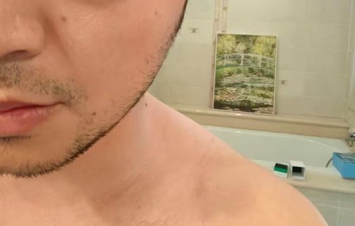 “别染发！”尼格买提自曝过敏照，一只眼睛肿到睁不开，网友：又心疼又好笑