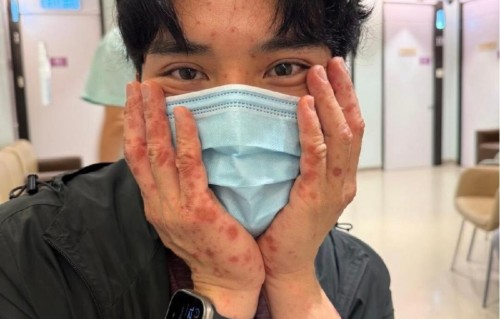 TVB知名男星欧洲行山出事，全身布满红疹，舌头肿胀入院吊点滴